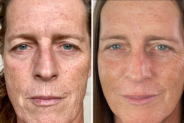 before-after Images
