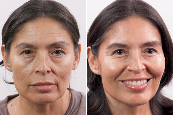 before-after Images