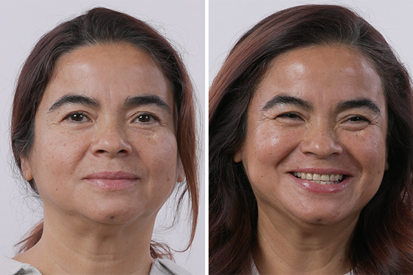 before-after Images