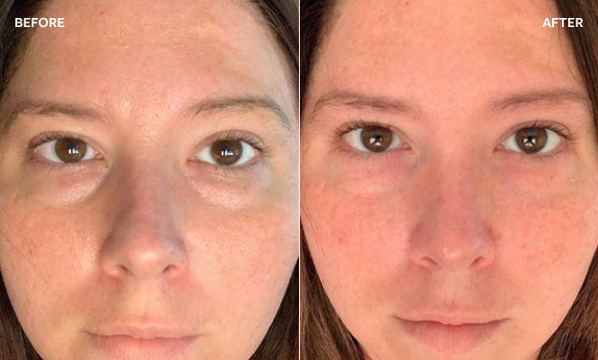 Before and after photos of a woman using Hanacure products.
