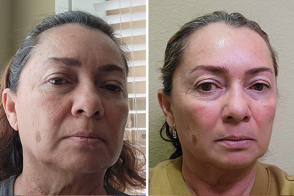 before-after Images