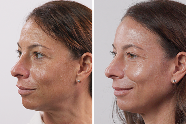 before-after Images