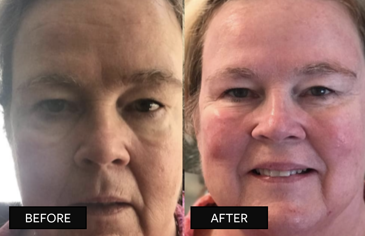 face comparision images before/after hanacure