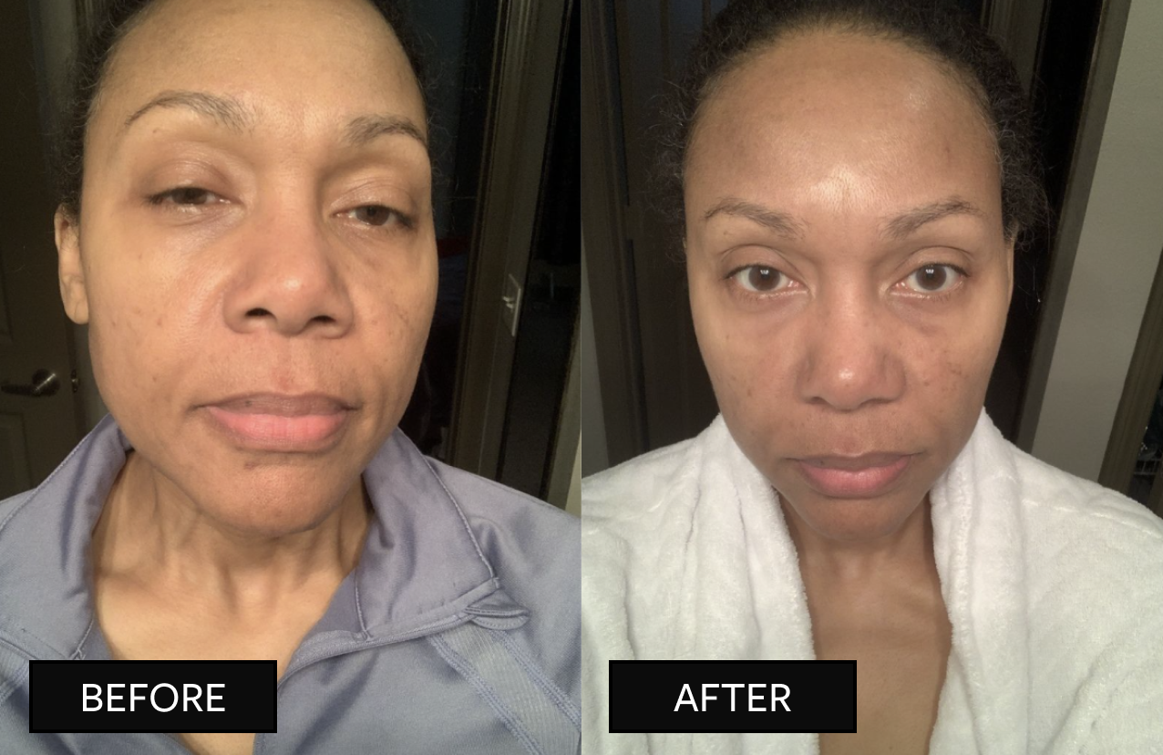 face comparision images before/after hanacure